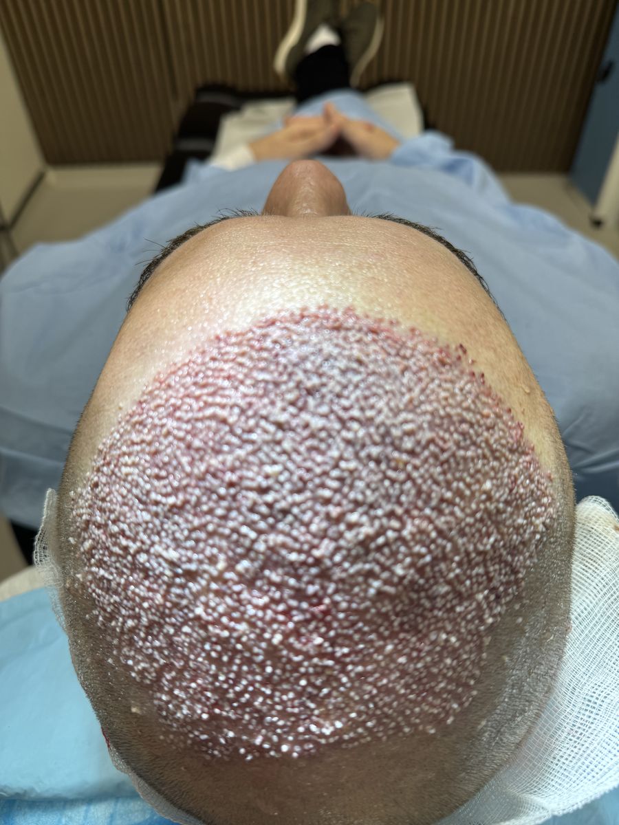 Close-up of recipient area immediately after hair transplant procedure showing fresh grafts